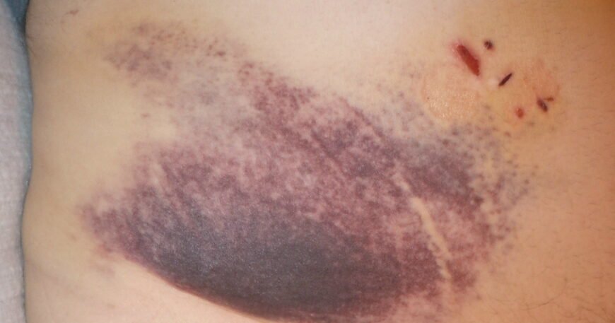 What Happens During Gallbladder Surgery?