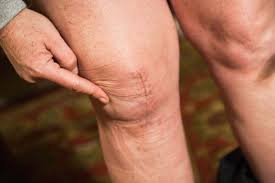 What Is Involved in a Knee Replacement?