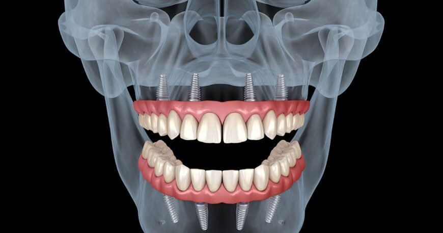 Why All-In-X Dental Implants Are a Beneficial Choice