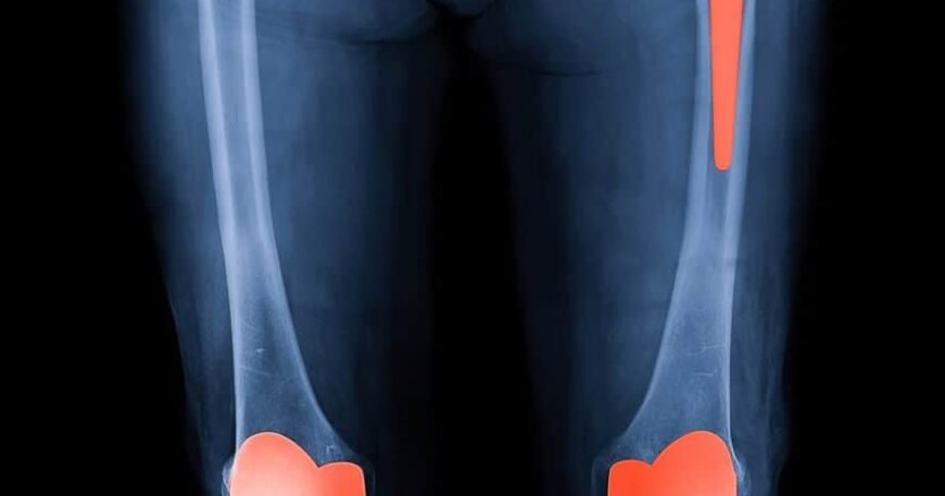 Exploring the Benefits of Joint Replacement Surgery
