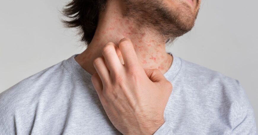 How a Dermatologist Can Help With Eczema Management