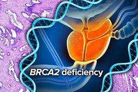 Prostate Cancer Treatment Options