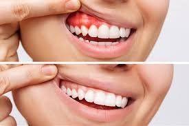Recognizing the Symptoms and Stages of Gum Disease