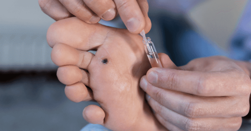 The Different Methods Used by Plantar Wart Specialists for Removal