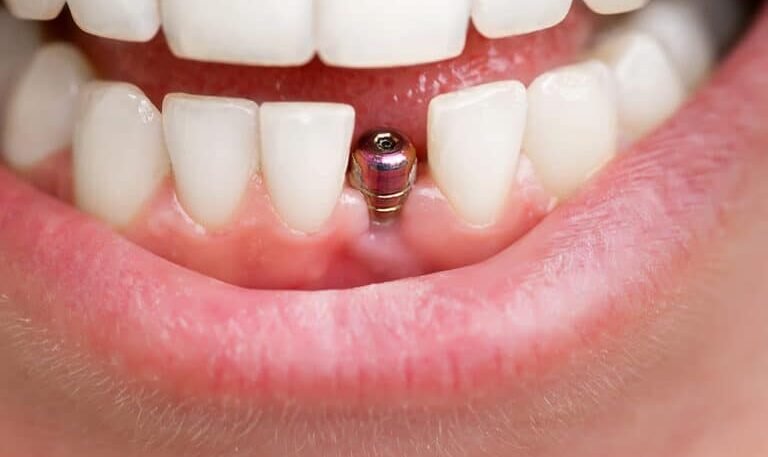 The Role of Dental Implants in Restoring Oral Health