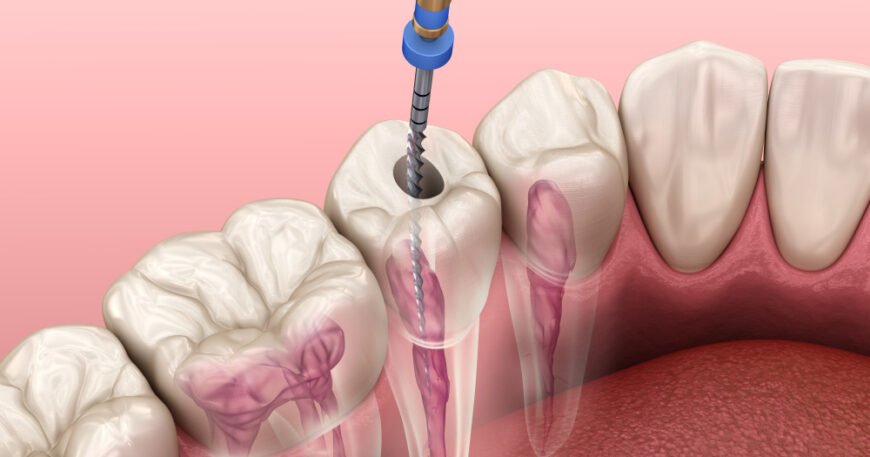 Understanding the Root Canal Procedure