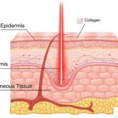 Understanding the Stages of Wound Healing