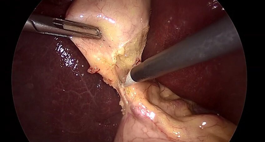 What To Expect During Gallbladder Removal Surgery