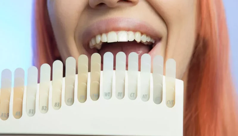 What to Discuss With Your Dentist Before Getting Veneers