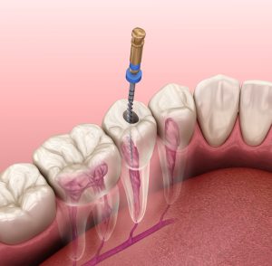 Frequently Asked Questions About Root Canals