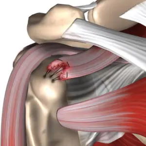 Rotator Cuff Surgery and What to Expect