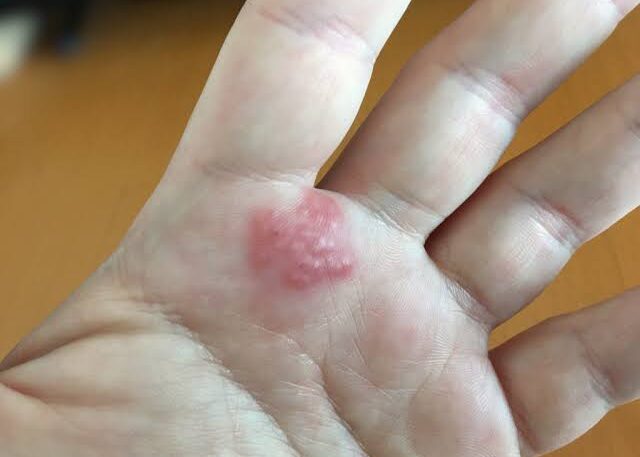 Skin Conditions Treated in Dermatology Clinics