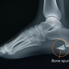 Understanding the Causes of Heel Pain