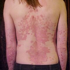 What Is Psoriasis?