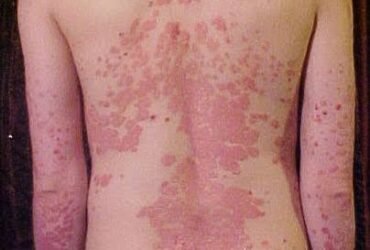 What Is Psoriasis What Is Psoriasis?