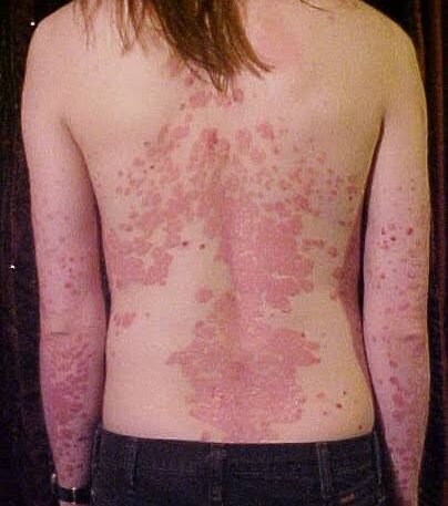 What Is Psoriasis?
