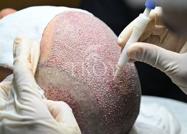 The Benefits of Hair Transplant for Hair Loss Solutions