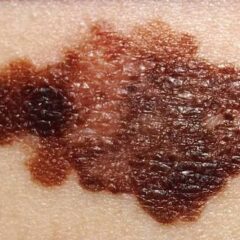 Understanding the Different Types of Skin Cancer and Their Symptoms